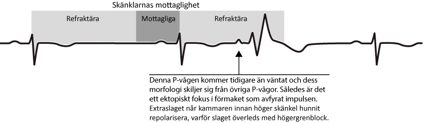 Figur 35. Aberrant överledning. Figuren visar hur ett supraventrikulärt extraslag anländer till kamrarna när höger skänkel är refraktär och slaget överleds med högergrenblocks-morfologi.