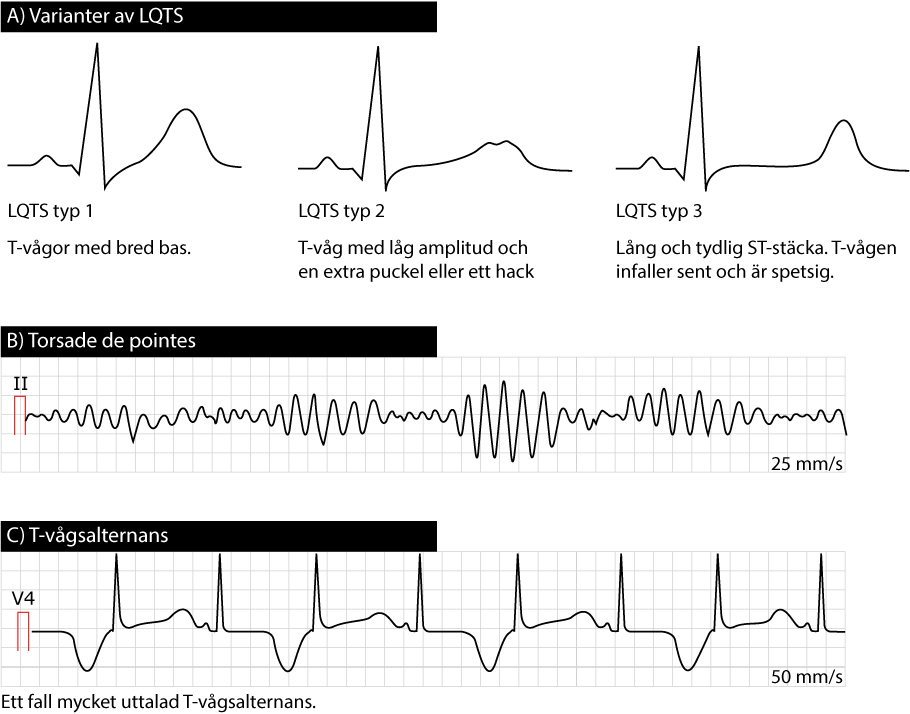 Figur 8. De tre vanligaste typerna av LQTS och deras karaktäristiska EKG-bild. Lång QT-tid leder till ventrikeltakykardi av typen torsade de pointes.