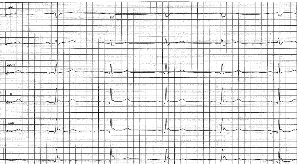 EKG med extremitetsavledningarna i ordningen aVL, I, −aVR, II, aVF och III. Långsam kammarfrekvens och en positiv deflektion direkt efter QRS-komplexet, tydligast i II, aVF och III.