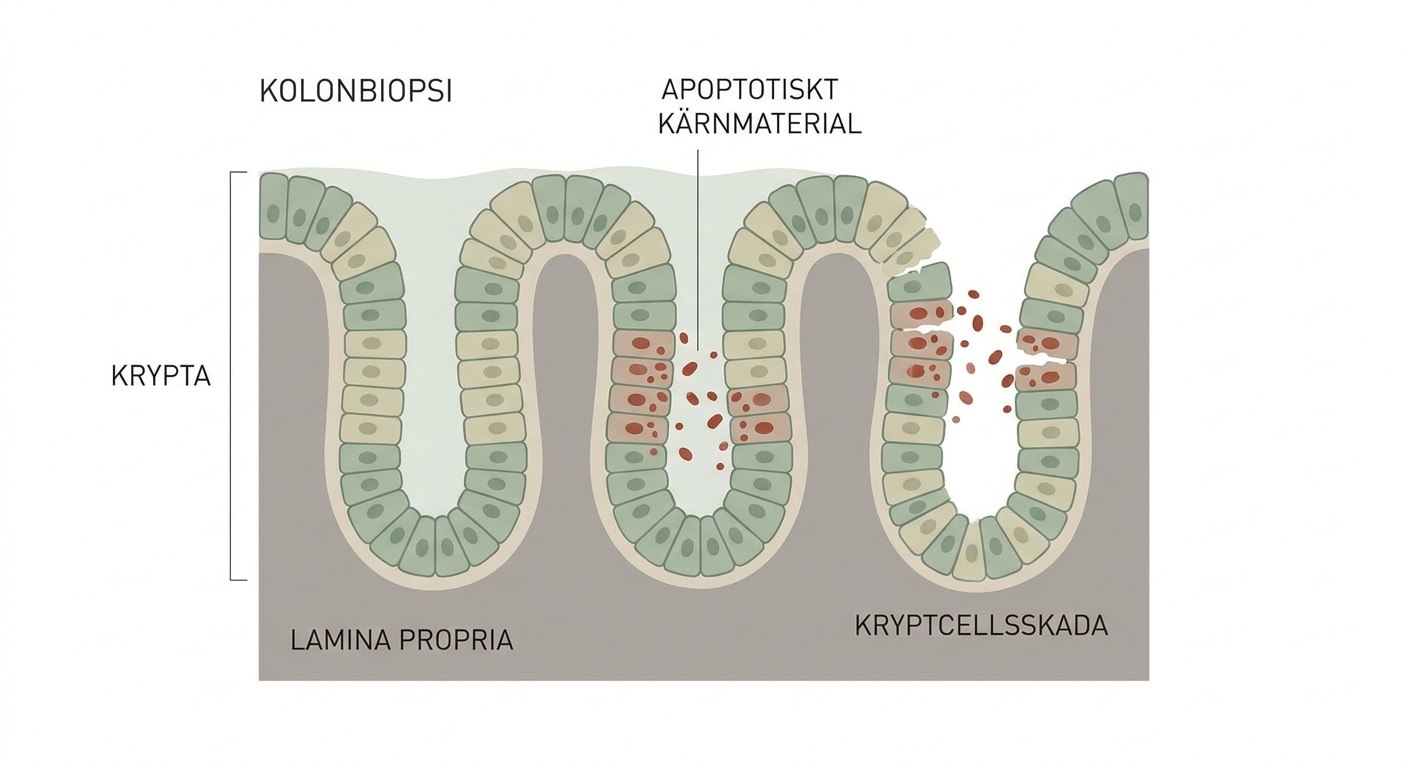 Kolonbiopsi med apoptotiskt kärnmaterial i kryptornas epitel vid gastrointestinal graft-versus-host-sjukdom.
