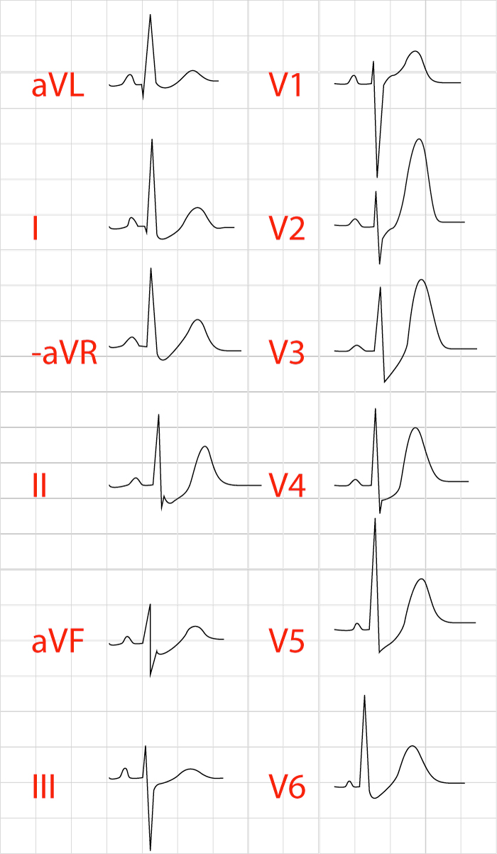 EKG med de Winters tecken: uppåtsluttande ST-sänkning och höga bredbasiga T-vågor i bröstavledningarna