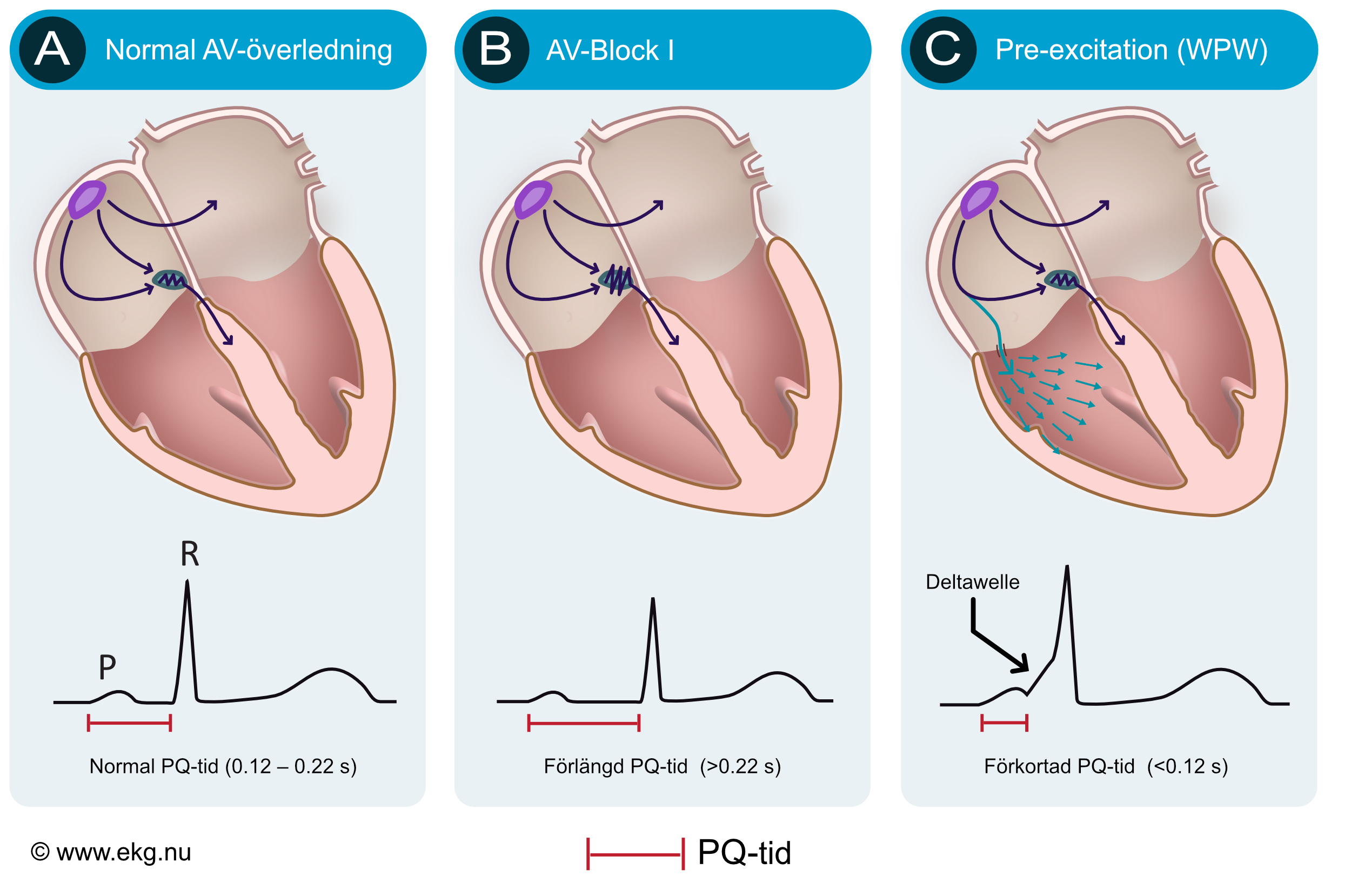 Schematisk jämförelse av normal AV-överledning, förlängd PQ-tid och preexcitation med accessorisk bana och deltavåg