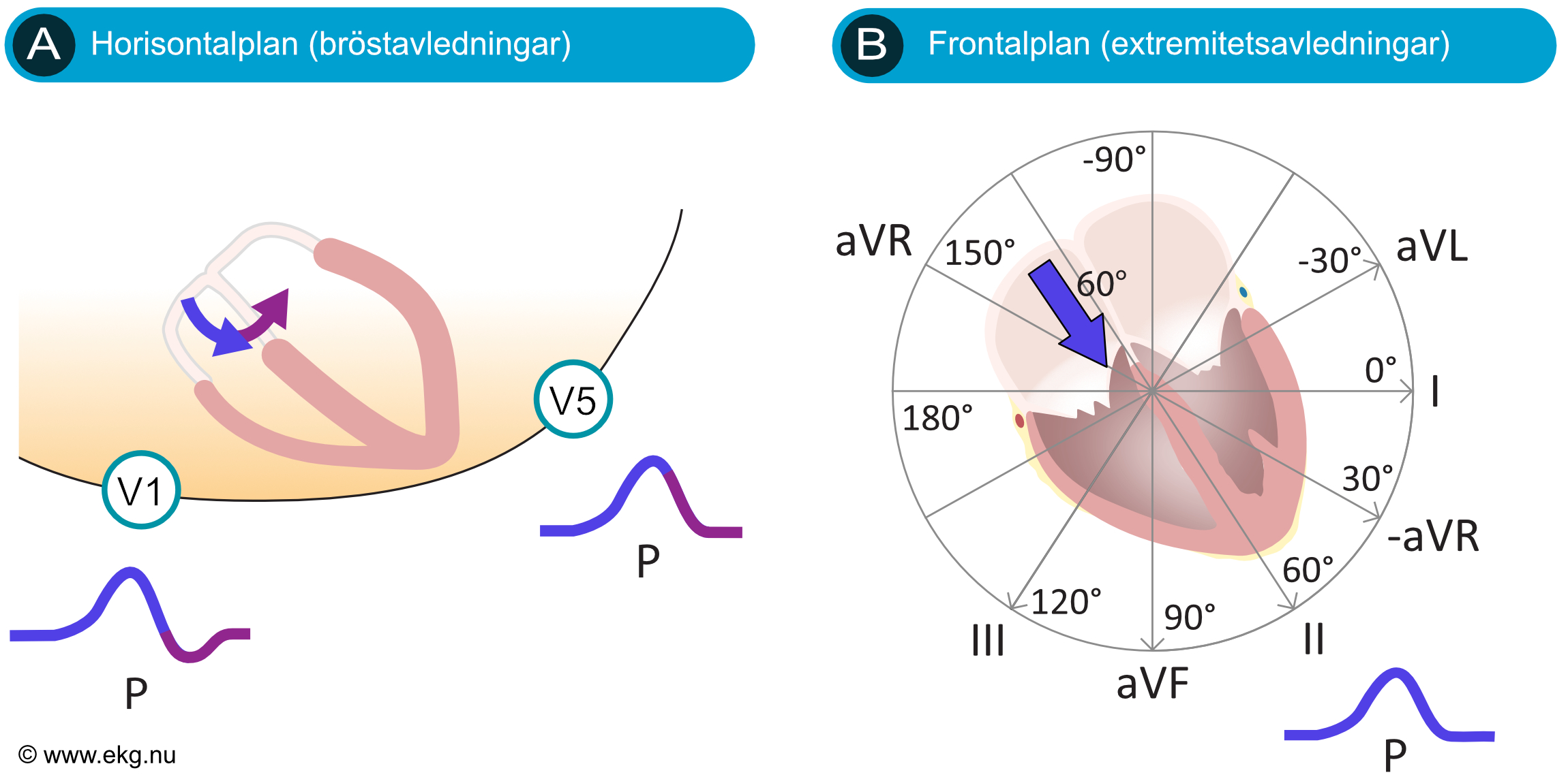 P-vågen i avledning II och V1 vid sinusrytm, med positiv våg i II och bifasisk våg i V1