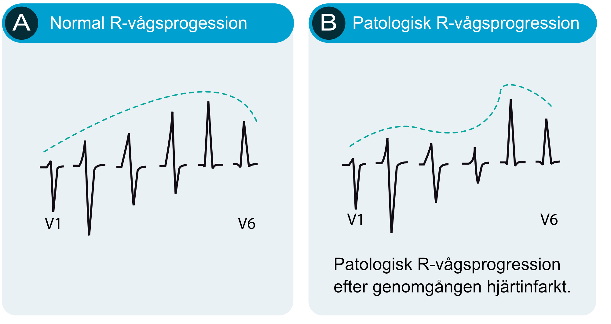 Normal R-vågsprogression från V1 till V6 jämförd med patologisk R-vågsprogression efter genomgången hjärtinfarkt.