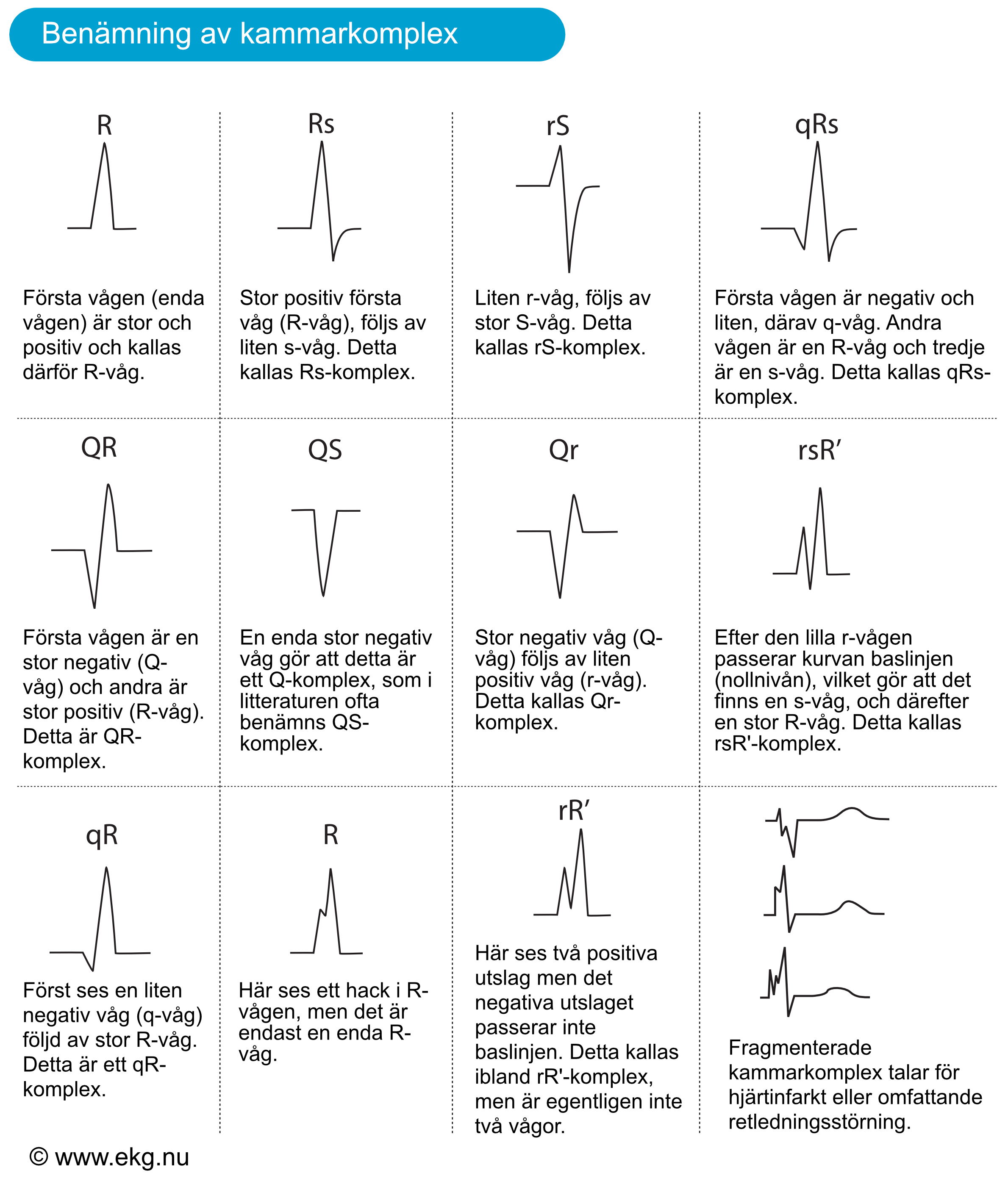 Exempel på QRS-komplex med olika benämningar av Q-, R- och S-vågor