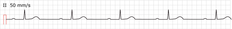 EKG-remsa med AV-block I där PQ-tiden är förlängd men varje P-våg följs av ett QRS-komplex