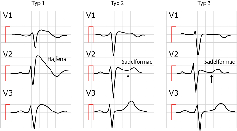 Figur 106. Brugada syndrom, tre varianter.