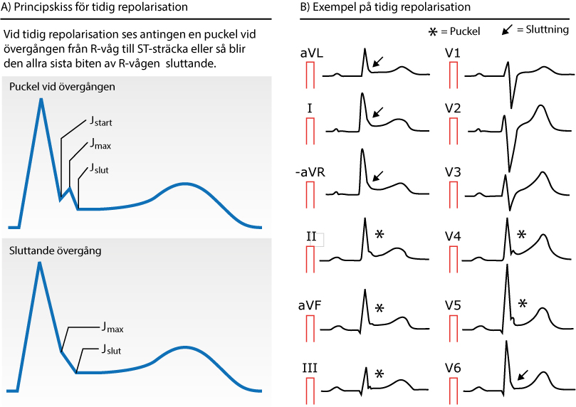 EKG med tidig repolarisation: J-punktshöjning och konkav ST-höjning i laterala och inferiora avledningar