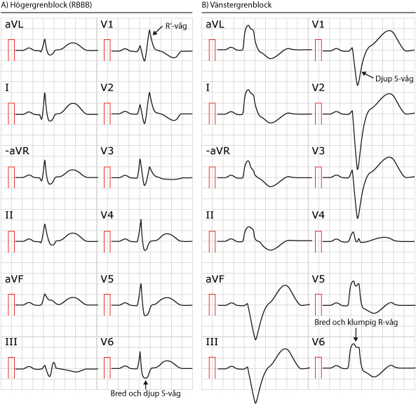 EKG med högergrenblock respektive vänstergrenblock med bredökade och karakteristiskt formade QRS-komplex