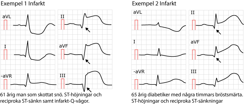 Två EKG från patienter med inferior ST-höjningsinfarkt med utvecklade Q-vågor i de inferiora avledningarna