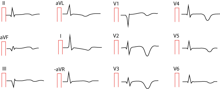 EKG med Wellens mönster: djupa symmetriska T-vågsinversioner i bröstavledningarna