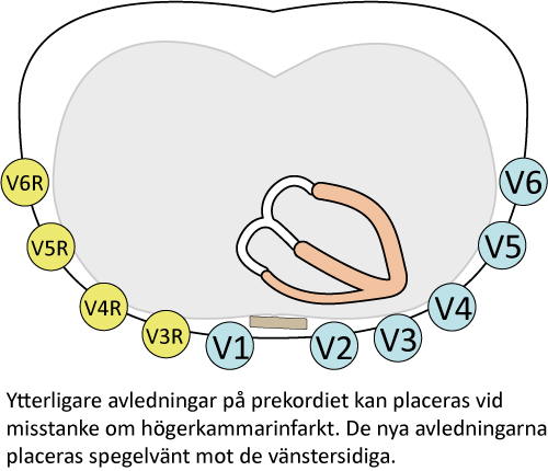 Figur 16. Högersidiga bröstavledningar vid högerkammarinfarkt. Dessa avledningar bör anbringas vid inferior infarkt för att utröna om även höger kammare drabbats.