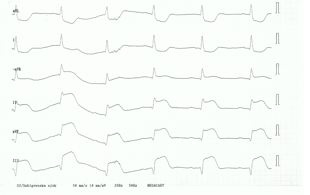 STEMI