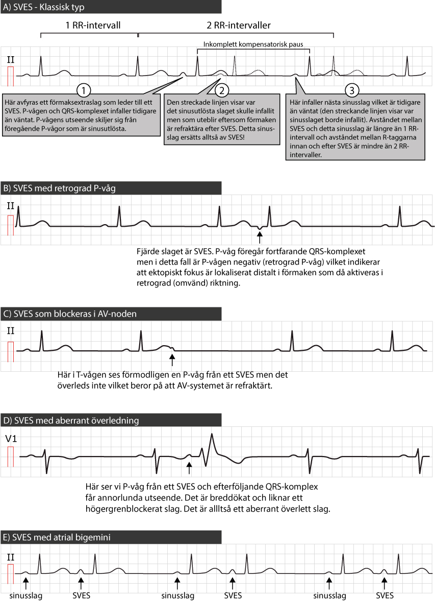 SVES EKG.nu SVES EKG.nu