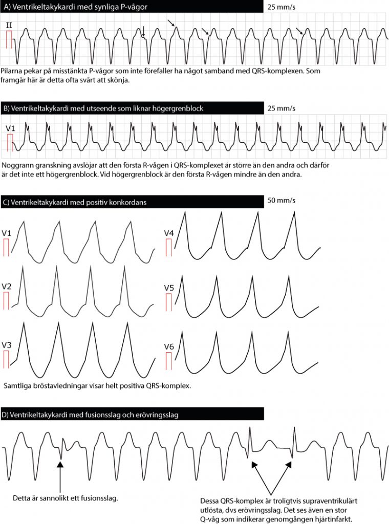 Figur 53. Ventrikeltakykardi. Flera varianter.