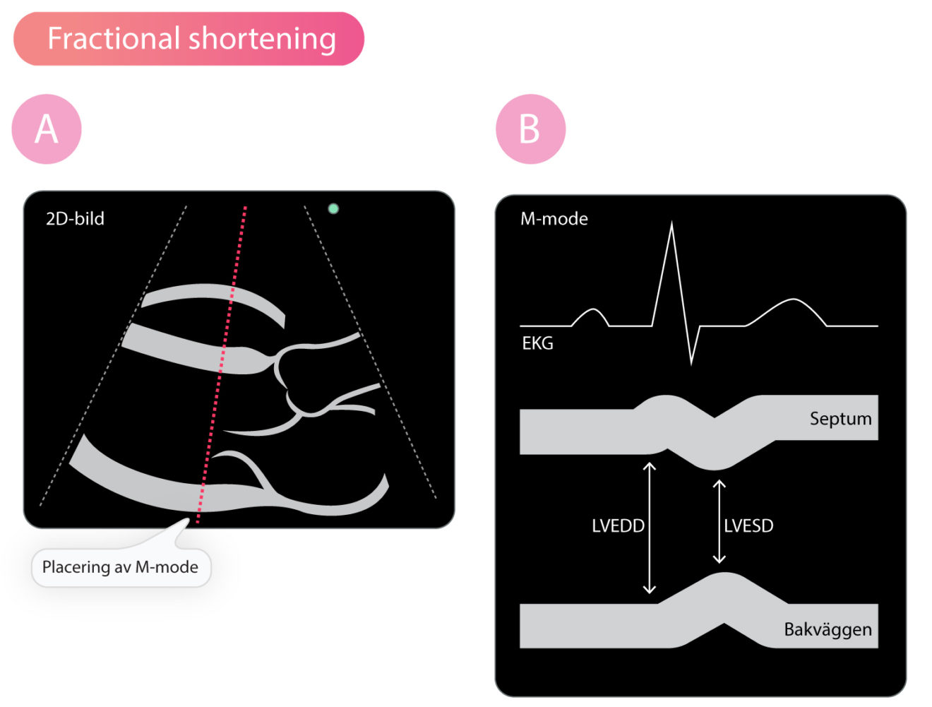 Fractional shortening (FS) Klinisk diagnostik