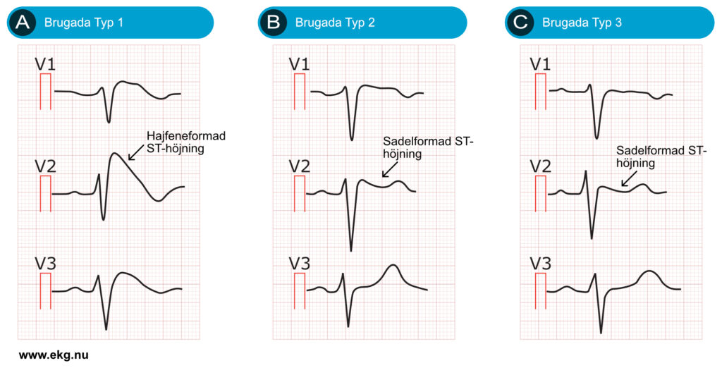 Brugada syndrom.