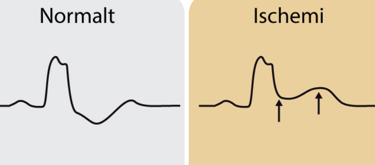 Kriterium 1: Konkordant ST-höjning