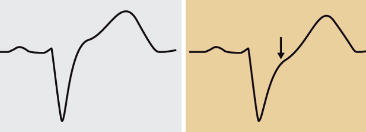 Kriterium 2: Konkordant ST-sänkning