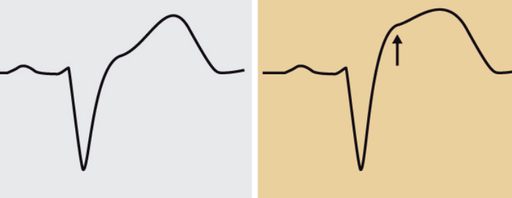 Kriterium 3: Diskordant ST-höjning