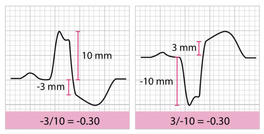 Kriterium 3: Diskordant ST-höjning med ST/S ≥25%